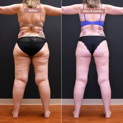 Cellumove 3D legging - say goodbye to lipedema pain and swelling naturally