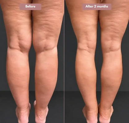 Cellumove 3D legging - say goodbye to lipedema pain and swelling naturally
