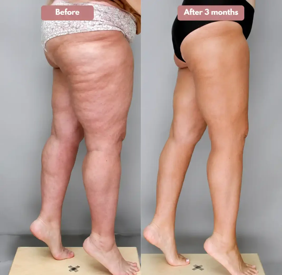 Cellumove 3D legging - say goodbye to lipedema pain and swelling naturally